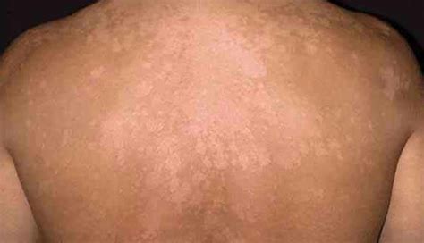 Dry Or White Patches On Skin Causes And Treatments