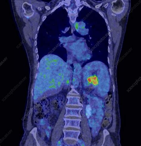 Pancreatic Cancer CT PET Scan Stock Image C Science