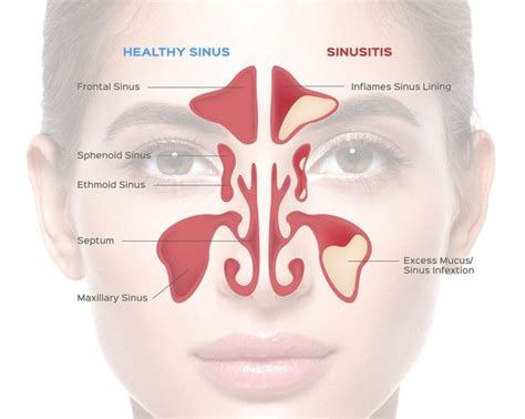 Nose Chronic Maxillary Sinusitis Dr Meenesh Juvekar Ent Specialist