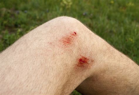 Signs And Symptoms Of Infection In A Scrape