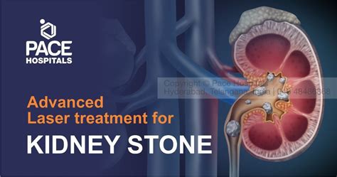 What Are Kidney Stones And What Are The Options For Kidney Stones