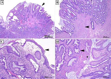 Classic Histological Features Of Mucosal Prolapse Syndrome A Polyp