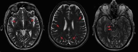 Structural Neuroimaging In Aging And Alzheimers Disease Radiology Key