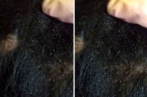 Hundreds Of Creepy Hair Lice Found On Girls Scalp By Hairdresser
