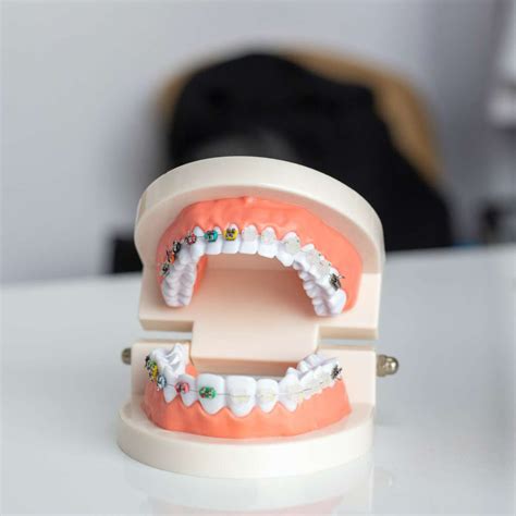 Transform Your Smile With Empower® Braces At Osgb