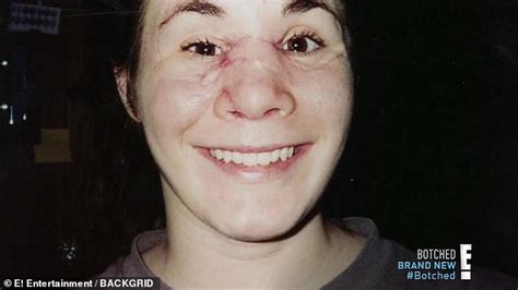 Mother Whose Face Was Rebuilt After A Drunken Car Crash Finally Has The