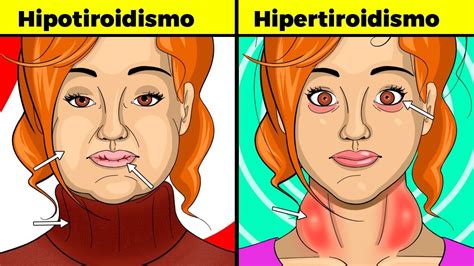 Síntomas De Tiroides En Mujeres Hipotiroidismo E Hipertiroidismo
