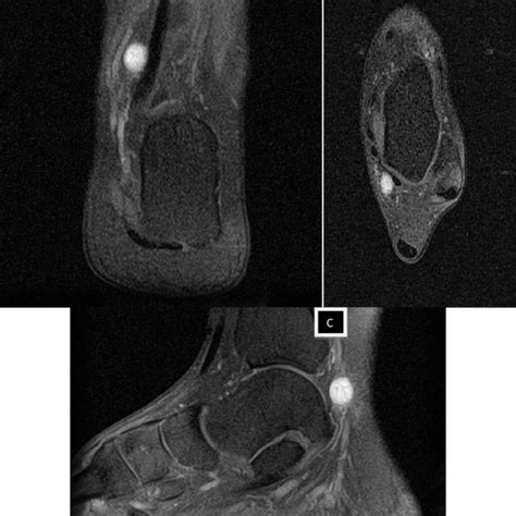 Pdf Posterior Tibial Nerve Schwannoma Mimicking Tarsal Tunnel Syndrome