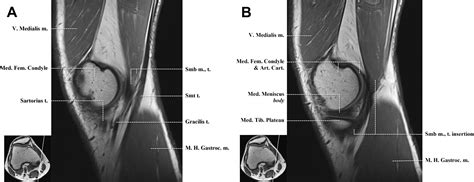 Normal Mr Imaging Anatomy Of The Knee Magnetic Resonance Imaging Clinics