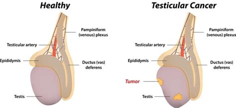 Testicular Cancer Classification Thailand Medical News