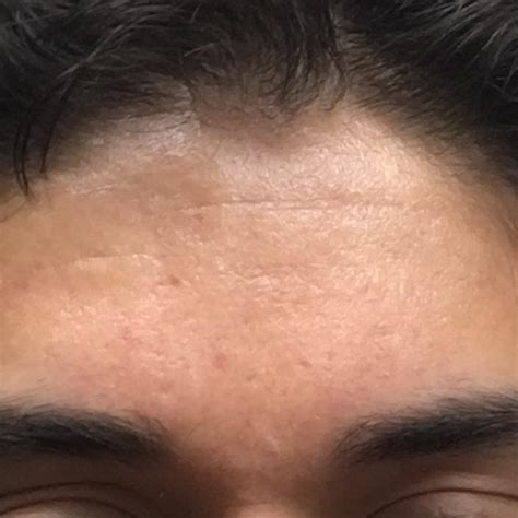 Treatment For My Forehead Scars Scar Treatments Community