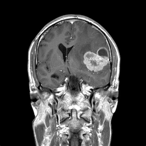 Brain Cancer Mri Scan Photograph By Du Cane Medical Imaging Ltd Fine