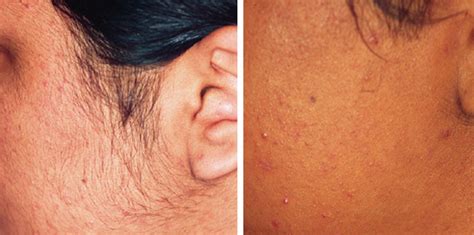 Before And After Hair Removal · Bareremoval