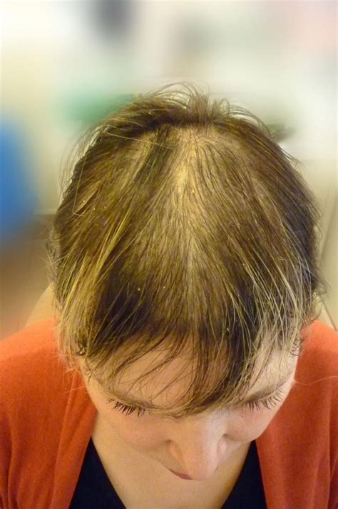 All About Hair Loss Stopbalding Hair Loss Treatment Androgenic