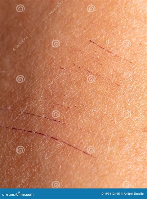 Scratches On Human Skin As Background Stock Image Image Of Accident
