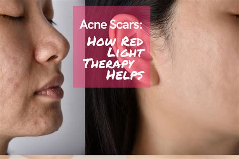 Red Light For Acne Scars Best Red Light Therapy