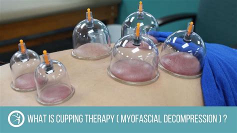 what is cupping therapy myofascial decompression