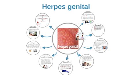 Herpes Genital By Deborah Ef On Prezi