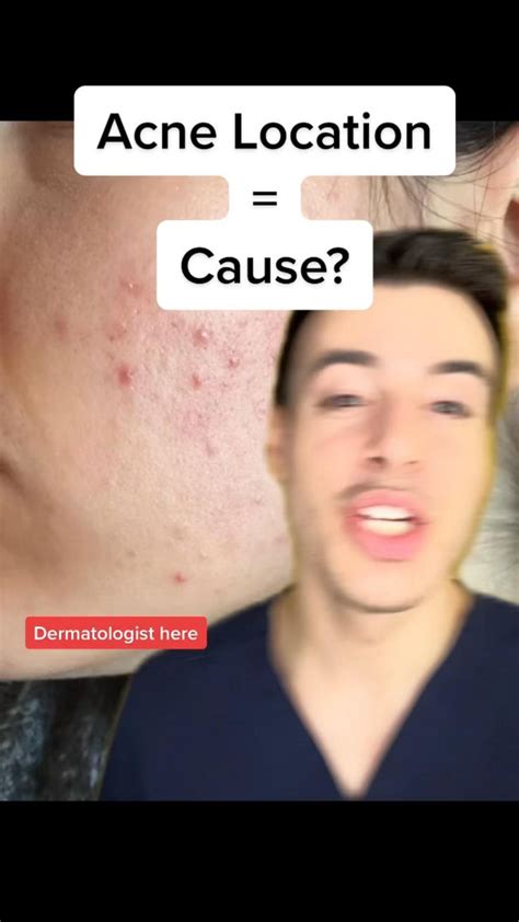 Acne Locationacne Cause And What You Can Do To Help Prevent Future