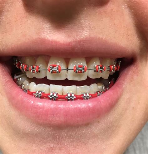 Pin By Jamie Richie On Braces And Retainers Orthodontics In 2020