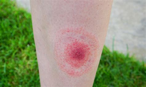New Lyme Disease Tests Could Offer Quicker More Accurate Detection