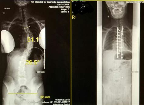 Before And After Spinal Fusion Surgery To Correct Scoliosis Son M17