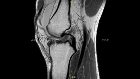 Lateral Tibial Plateau Fracture Complete Mri Examination Youtube