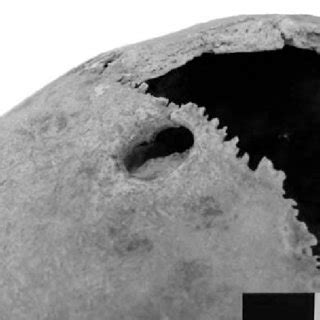 A crown in head would define the horisontal plane. Volume rendering technique (VRT), coronal plane /virtual ...