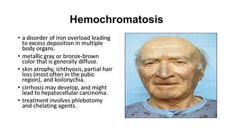 Hemochromatosis Bronze Skin