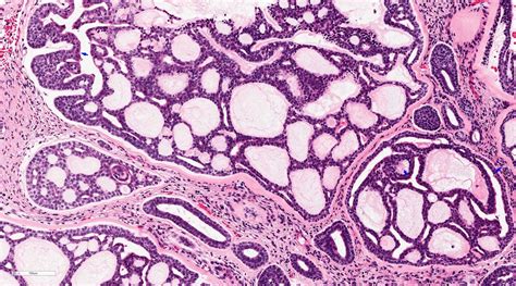 Mucoepidermoid Carcinoma Parotid Pathology Outlines Fititnoora