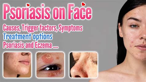Psoriasis On Face Causes Symptoms Trigger Factors Types
