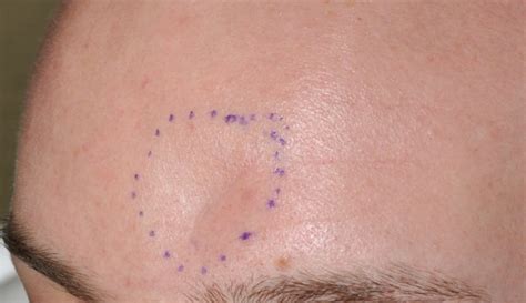 Forehead Dent Outlines Oblique View Dr Barry Eppley Indianapolis