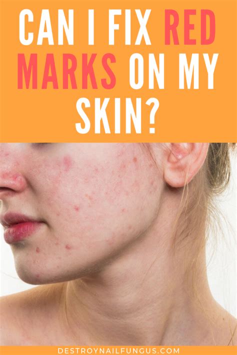 Jul 26, 2019 · you can use any of the following treatments 3 or 4 times a week: Simple Remedies to Treat Your Blotchy Skin