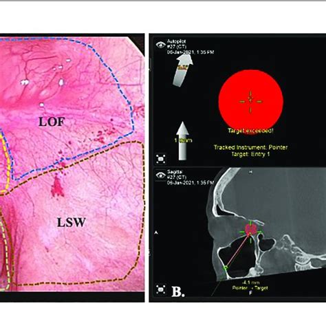 Endoscopic View Of Transmaxillary Approach With The Download