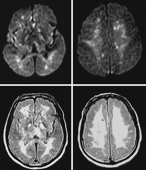 Hypoxic Ischemic Brain Damage Radiology Key