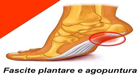 Fascite Plantare E Agopuntura Come Curare La Fascite Plantare Agopuntura A Roma Mtc YouTube