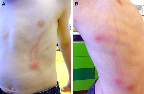 Recurrent Superficial Lymphangitis After Insect Bites Archives Of