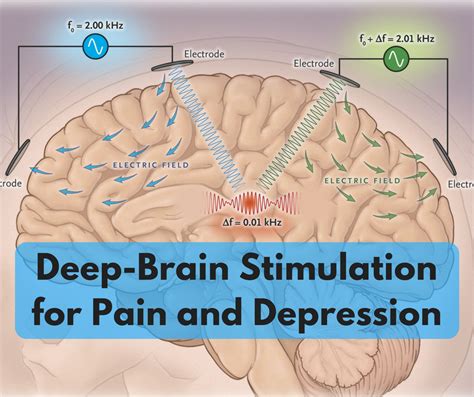 Deep Brain Stimulation For Pain And Depression Center For