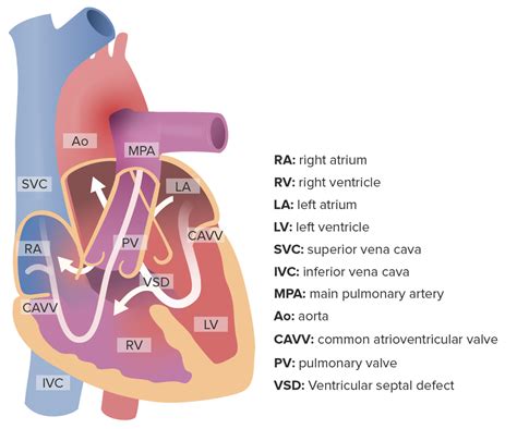 Atrioventricular Septal Defects And Atrioventricular Valve Anomalies