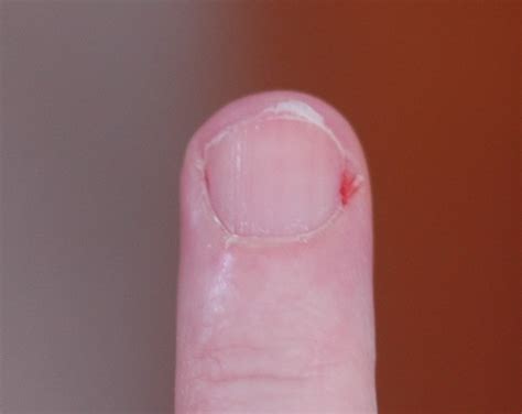 Padrastros de las uñas las causas el tratamiento y la prevención