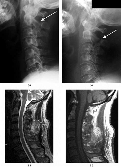 Imaging Of Acute Cervical Spine Injuries Review And Outlook Clinical