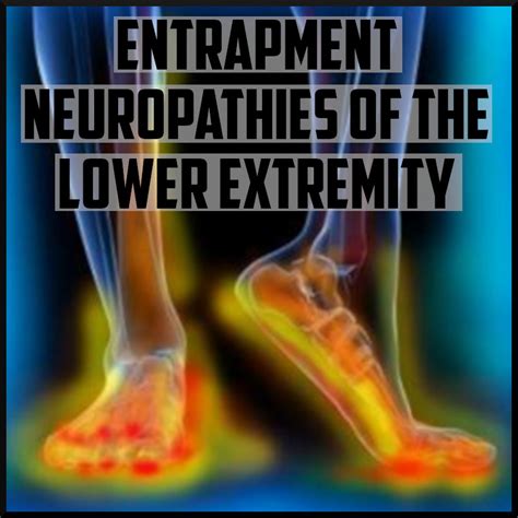 Common Entrapment Neuropathies Of The Lower Extremity — The Sports
