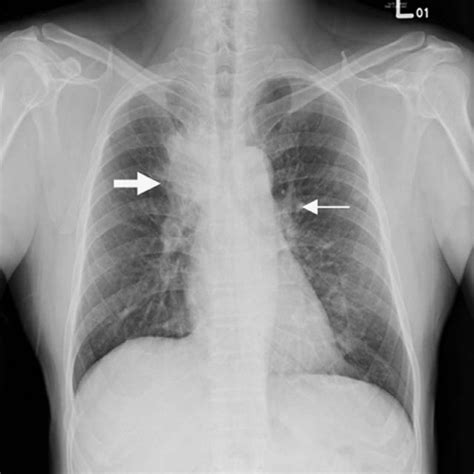 Chest X Ray Shows Right Suprahilar Tumor Thick Arrow And