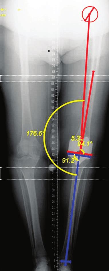 Hip Knee Ankle X Ray Of The Patient With Varus Knee Osteoarthritis Fva
