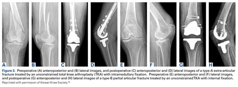 Primary Total Knee Arthroplasty For Distal Femur Fractures A