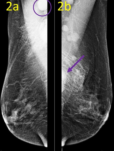 Postbiopsy Mammogram Mediolateral Oblique Mlo Views These Postbiopsy