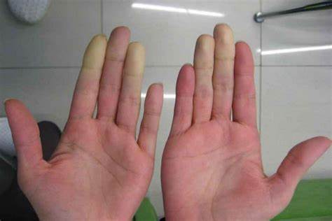 Рейно болезнь диета Болезнь Рейно: причины, симптомы, народное лечение, как лечить Болезнь Рейно: причины, симптомы, народное лечение, как лечить Рейно болезнь диета