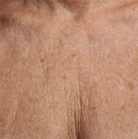 Neckchest And Aged Skin Faciem Dermatology Clinic