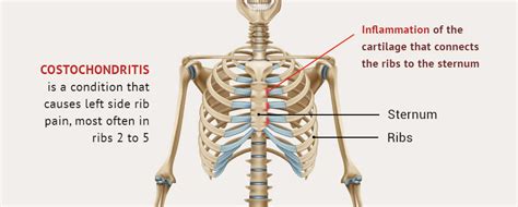 Organs Underneath Back Rib Cage 10 Causes For Pain Below The Ribs