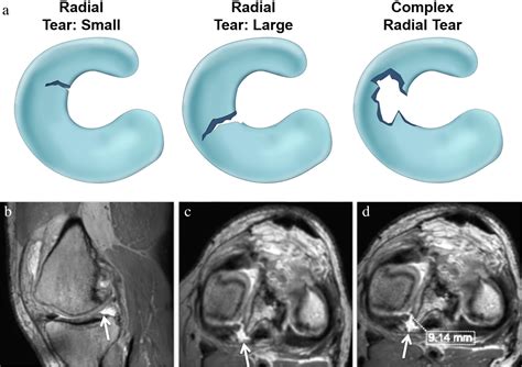 Isakos Classification Of Meniscal Tears—illustration On 2d And 3d